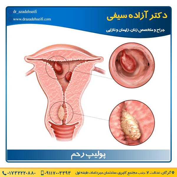 پولیپ رحم